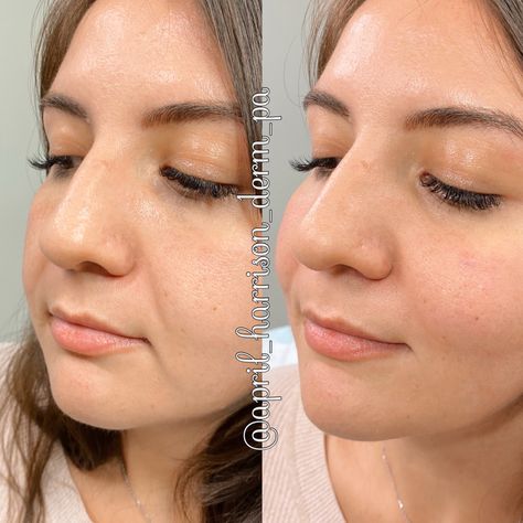 Cheek filler to lift and recontour Natural Cheek Filler, Face Fillers Before And After Cheeks, Cheek Filler Injection Sites, Medial Cheek Filler, Keyhole Pout Lip Filler, Cheek Lift, Cheek Fillers, Facial Aesthetics, Double Chin