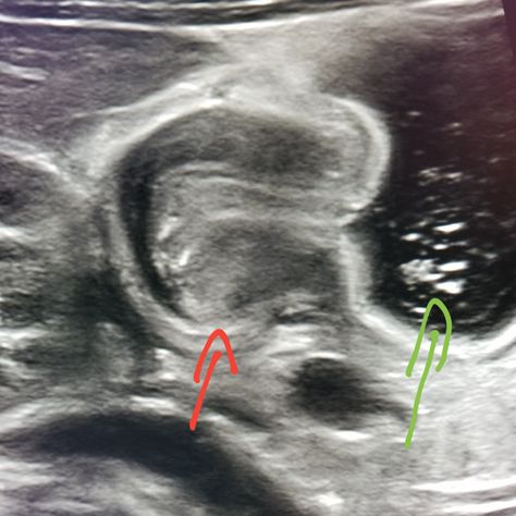 #Abdomen #ultrasound shows a thickened #pyloris in a #baby with #pyloric #stenosis. Green is the stomach. #radiology #radiologist Abdomen Ultrasound, Pyloric Stenosis, Fetal Ultrasound, Abdominal Ultrasound, Medical Sonography, Ultrasound Sonography, Medical Ultrasound, Diagnostic Medical Sonography, Ultrasound Technician