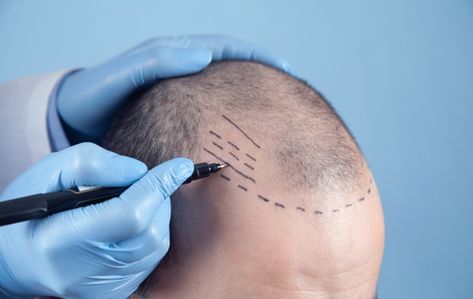 Hair Transplant Myths and Facts: Common Misconceptions Hair Medicine, Hairline Tattoos, Hair Implants, Hair Transplant Cost, Hair Plugs, Hair Transplant Procedure, Dunner Wordend Haar, Scalp Micropigmentation, Fue Hair Transplant