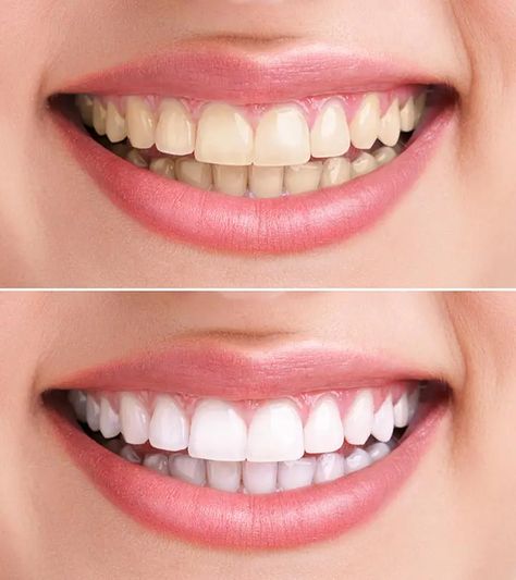 Hydrogen Peroxide For Teeth Whitening – 6 Home Remedies To Whiten Teeth Kesehatan Gigi, Teeth Whitening Remedies, Laser Teeth Whitening, Whiter Teeth, Teeth Whitening Pen, Porcelain Veneers, Yellow Teeth, Best Teeth Whitening, Natural Teeth Whitening