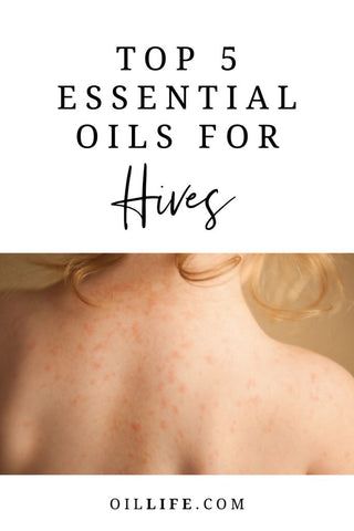 The Top 5 Best Essential Oils For Hives - Oil Life Essential Oils For Rash, Essential Oil For Hives, Natural Remedies For Hives, Hives Remedies, Essential Oils For Congestion, Esential Oils, Essential Oils Guide, Essential Oil Spray, Yl Essential Oils