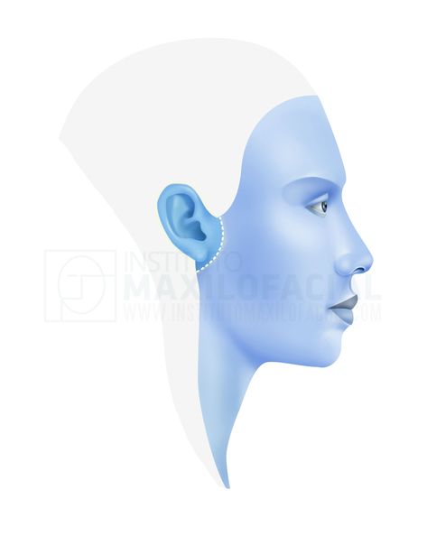 Aesthetic ear surgery at Instituto Maxilofacial Ear Surgery, Facial Aesthetic, Aesthetic Surgery, Facial Plastic Surgery, Facial Plastic, Cosmetic Surgery, E Books, Best Diy, Not Afraid