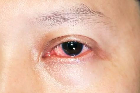 Before heading to the doctor, try one of the many home remedies for red eyes. Redness of the eyes can sometimes be reduced by gently washing them, relaxing Red Eyes Remedy, What Causes Red Eyes, Goopy Eyes, Glassy Eyes, Allergy Eyes, Strained Eyes, Bloodshot Eyes, Swollen Eyes, Irritated Eye