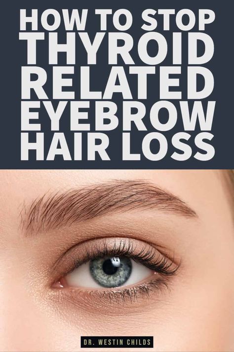 Eyebrow hair loss is one of the most common symptoms of low thyroid function or hypothyroidism! If you are experiencing eyebrow hair loss then you must get your thyroid checked. This doesn't guarantee that your hair loss is caused by your thyroid but it's something that must be ruled out. Learn more about how hypothyroidism causes eyebrow hair loss and how to treat it here. Pins Colada, Eyebrow Regrowth, Eyebrow Loss, Thyroid Removal, Low Thyroid Symptoms, Low Thyroid Remedies, Thyroid Hair, Thyroid Remedies, Home Remedies For Allergies