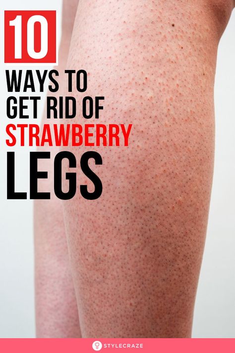 Bumps On Legs, Brown Age Spots, Brown Spots On Skin, Strawberry Legs, Beauty Hacks Skincare, Brown Spots Removal, Brown Spots On Face, Skin Spots, Spots On Face