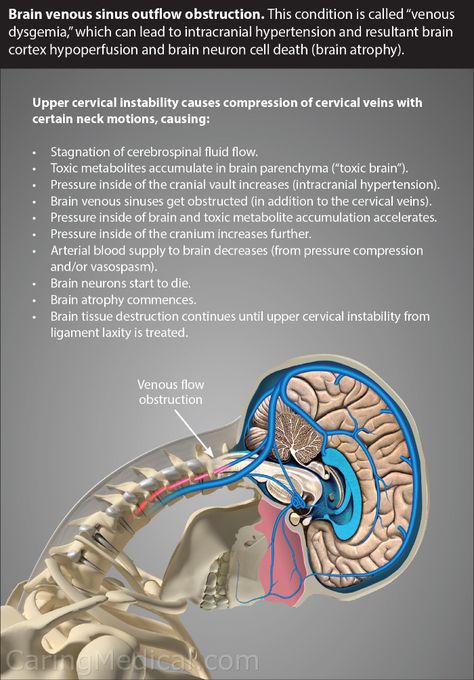 Occipital Neuralgia, Vertebral Artery, Intracranial Pressure, Spinal Fluid, Cerebrospinal Fluid, Brain Tissue, Cervical Spine, Stem Cell Therapy, Neck Pain Relief