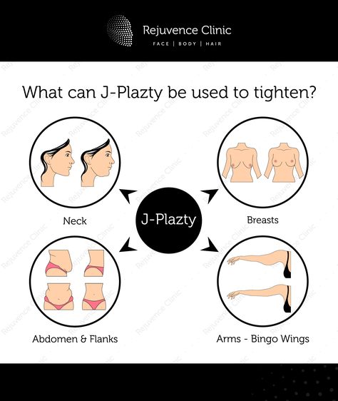 J-Plazty is a minimally invasive technique that can be used to tighten loose and crepey skin in different parts of the body that result from the normal aging process as well as following weight loss.  Rejuvence Clinic is the first and only clinic in the UK to offer J-plazty. J-Plazty was originally developed by Dr Jack Zamora in Denver, Colorado. We use exactly the same technique and are a twinned clinic. Contact us for a free consultation. 📞 +442075316600 Bingo Wings, Tighten Loose Skin, Crepey Skin, Parts Of The Body, Loose Skin, Aging Process, Skin Tightening, Denver Colorado, Free Consultation