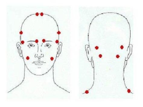 Scientists in Spain have identified the location of the so-called trigger points that, when activated, cause migraine crises. The common location of these points are the anterior temporal and the suboccipital regions of the head –both at bilateral level. Botox Migraine, Punkty Spustowe, Botox Injection Sites, Injection Sites, Cosmetic Dentistry Veneers, Migraine Help, Occipital Neuralgia, Headache Relief Instant, Botox Before And After