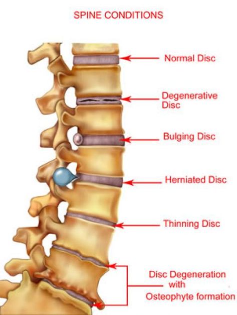 Herniated Disks and Other Spinal Conditions That Can Lead to Sciatica Related Lower Back Pain Bulging Disc, Bolesti Chrbta, Spine Health, Back Pain Remedies, Sciatica Pain, Medical Anatomy, Sciatic Nerve, Chiropractic Care, Med Student