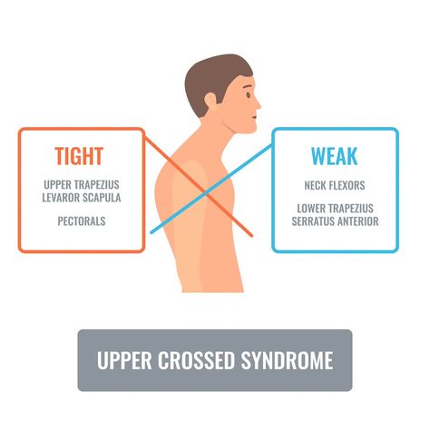 Upper Cross Syndrome Exercises, Head Exercises, Upper Cross Syndrome, Posture Correction Exercises, Neck Ache, Neck Hurts, Muscles Of The Neck, Forward Head Posture, Neck Exercises