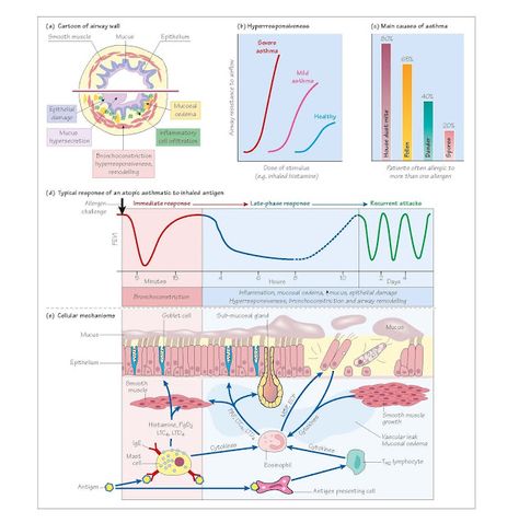 Asthma: pathophysiology   Asthma is an inflammator disorder of the airways. Patients suffer from episodes of cough, wheezing, chest tight... Asthma Pump Aesthetic, Asthma Pathophysiology, Mucus Plug, Physician Assistant School, Sensory Nerves, Medical School Studying, Asthma Attacks, Viral Infection, Physician Assistant