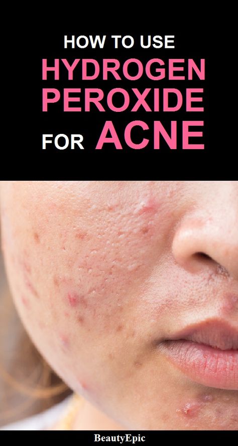 4 Easy Ways to Get Rid of Acne Fast with Hydrogen Peroxide Hydrogen Peroxide For Acne, Hydrogen Peroxide Acne, Peroxide For Acne, Peroxide Uses, Chest Acne, Hydrogen Peroxide Uses, Acne Overnight, Skin Care Routine For 20s, Body Acne