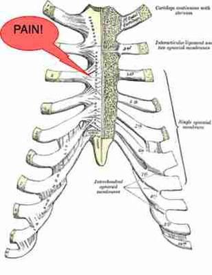 For over a month I have had right thoracic spine rib pain at T7. I don't know what initiated it. It started as just being a little sore and uncomfortable Chest Pain Relief, Trapped Nerve, Rib Pain, Natural Headache Remedies, Sciatic Nerve Pain, Chest Muscles, Sciatic Nerve, Joints Pain Relief, Headache Relief