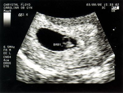 6 week ultrasound of a BABY that MATTERS! 3 Weeks Pregnant Ultrasound, 5 Weeks Pregnant Ultrasound, 6 Weeks Pregnant Ultrasound, 3 Weeks Pregnant, Pregnant Ultrasound, 6 Weeks Pregnant, Pregnancy Week, Baby Ultrasound, Family Relations