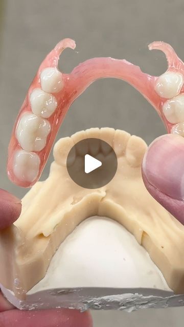 Dentures Before And After Immediate, How To Make Dentures At Home, Snap On Dentures, Best Denture Adhesive, Complete Denture Before And After, Removable Partial Denture, Partial Dentures, Dentures, Michigan