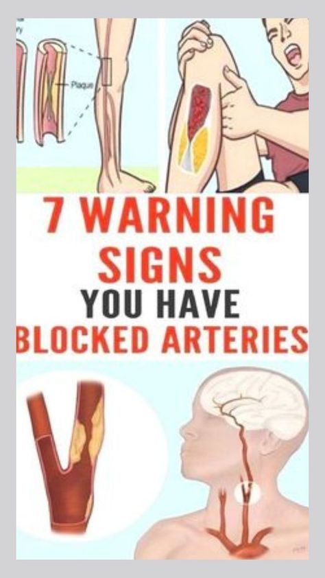 Here Are 7 Warning Signs You Have Blocked Arteries Bad Circulation, Clogged Arteries, Endocannabinoid System, Health Signs, Poor Circulation, Heart Problems, Natural Health Remedies, Sciatica, Health Facts