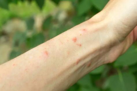 Shingles vs. Poison Ivy: How to Tell the Difference Skin Rashes Pictures, Common Skin Rashes, Shingles Rash, Poison Ivy Rash, Types Of Rashes, Rash Causes, Itchy Rash, Poison Oak, Skin Moles