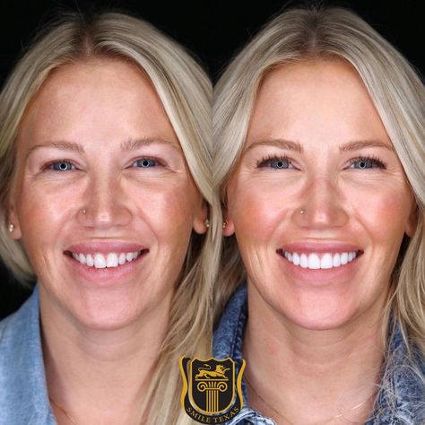 Cosmetic Dentist Houston TX | Dental Implants Sugar Land | Veneers TX Veneers Before And After, Dental Esthetics, Teeth Transformation, Virtual Consultation, Dental Cavities, Perfect Teeth, Teeth Implants, Dental Veneers, Nice Teeth