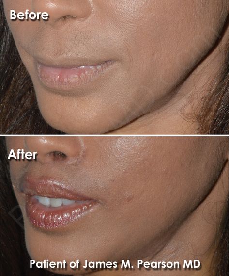 Lip Lift Before And After, Lip Lift Surgery, Lip Flip, Lip Surgery, Lip Lift, Nose Jobs, Rhinoplasty Nose Jobs, Facial Plastic Surgery, Facial Plastic