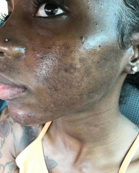 I used to suffer from hormonal & cystic acne. From around 2007-2019 I was going back & forth to the dermatologist. It was hell. My skin got worst & worst. The scarring, the dark spots, the texture, the enlarged pores & inflammation put me in a terrible mental health crisis at times. I was caking on makeup & picking my skin every single day. I went & got shots at the derm for the under the skin cysts several times a month. I spent 1,000s of dollars...I even tried #accutane but I relapsed. It g... Hormonal Cystic Acne, Pimples On Scalp, Pimple Causes, Bad Skin, Bad Acne, Clean Blackheads, Skin Aesthetics, Bleaching Cream, Natural Acne Remedies