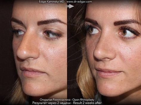 Bulbous Nose Before And After Nose Surgery (1) » Rhinoplasty: Cost, Pics, Reviews, Q&A Bulbous Tip Rhinoplasty, Bulbous Nose Rhinoplasty Before After, Bulbous Nose Rhinoplasty, Tip Rhinoplasty, Kpop Plastic Surgery, Nose Rhinoplasty, Jaw Reduction Surgery, V Line Surgery, Bulbous Nose