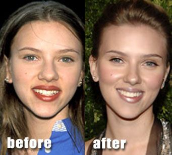 Had no idea ScarJo had work done.  Still think she's gorgeous though. Celebrity Surgery, Bulbous Nose, Rhinoplasty Nose Jobs, Rhinoplasty Before And After, Perfect Nose, Nose Surgery, Facial Plastic Surgery, Celebrity Plastic Surgery, Celebrities Before And After