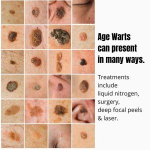 Phenol Peel, Seborrheic Keratosis, Flat Warts, Types Of Warts, Facial Warts, Remove Skin Tags Naturally, Remove Warts, Wart Remover, Makeup Looks Natural