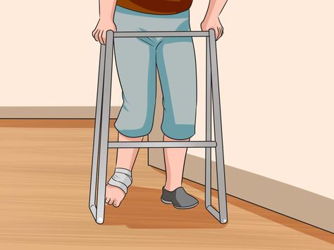 An ankle sprain is one of the most common injuries. It is stretching or tearing of the ligaments that support the ankle. Sprains occur most commonly in the ATF (anterior talofibular) ligament because it runs along the outside of your... Hairline Fracture, Ankle Sprain, Basic First Aid, Bone Fracture, Ankle Braces, Sprained Ankle, First Aid, Chronic Pain, How To Know