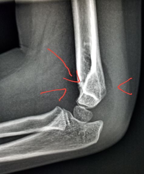 #Elbow #Xray shows #fracture (arrow: #suprachondylar) with a #joint #effusion (arrowhead) in a #child  who #fell. #radiologist #radiology #pain #injury #trauma Elbow Xray, Radiology, X Ray, A Child, Neon Signs, Quick Saves