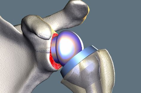 Facing Shoulder Surgery? Is Joint Replacement or Fusion Best for You? – Health Essentials from Cleveland Clinic Reverse Shoulder Replacement, Sinus Massage, Shoulder Replacement Surgery, Rotator Cuff Tear, Neck Problems, Shoulder Surgery, Knee Surgery, Rotator Cuff, Knee Replacement