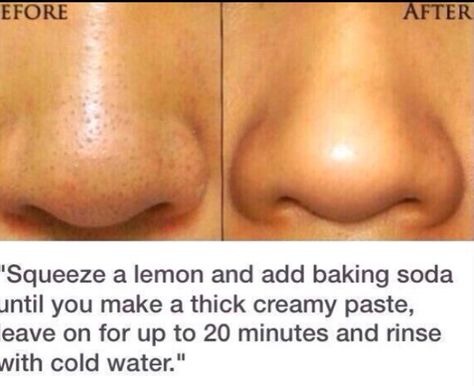 Health tips Jus Lemon, Blackhead Remedies, Black Heads, Get Rid Of Blackheads, Beauty Remedies, Acne Remedies, Skin Pores, Homemade Beauty Products, Health And Beauty Tips