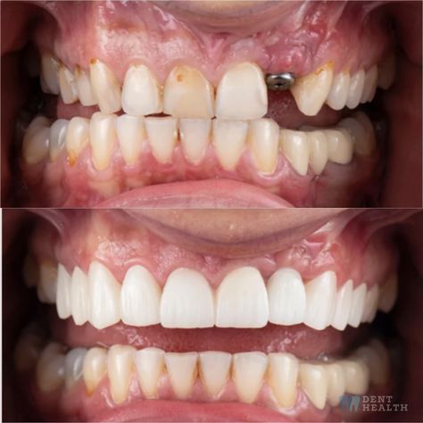 Teeth Implants Before And After, Dental Implants Before And After, Dental Implant Procedure, Missing Teeth, Teeth Implants, Dental Art, Dental Implant, Perfect Smile, After Photos