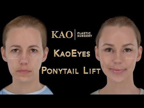 Facelift Without Scars? The Future of Plastic Surgery? Ponytail Lift or Ponytail Facelift? - YouTube Ponytail Lift, Facelift Surgery, Facelift Before And After, Face Lift Surgery, I Knew It, Face Lift, Summer Makeup, Plastic Surgery, Picture Perfect