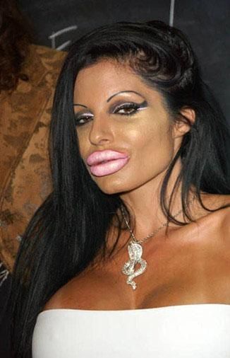 Bad Lip Injections, Plastic Surgery Pictures, Kylie Jenner Piercings, Lip Surgery, Plastic Surgery Fail, Plastic Surgery Gone Wrong, Lip Augmentation, Celebrity Plastic Surgery, Reconstructive Surgery