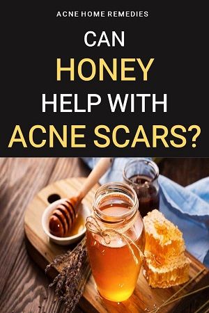 Food For Acne, Honey For Acne, Acne Scaring, Acne Diet, Acne Scarring, Diy Acne, Natural Acne Remedies, Natural Acne, Home Remedies For Acne