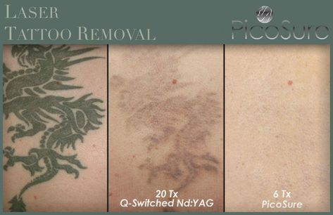 Picosure Laser Tattoo Removal #tattooremovaldiy Tattoo Eraser, Picosure Tattoo Removal, Shooting Star Tattoo, Tattoo Removal Cost, Tattoo Cream, Laser Tattoo, Laser Tattoo Removal, Tattoo Removal, Permanent Tattoo