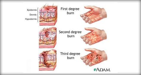 Focus on the major priorities of any trauma patient; the burn wound is a secondary consideration, although aseptic management of the burn wounds and invasive lines continues. Burns Nursing, Burn Injury, First Aid Tips, Degree Burns, Cooking Pasta, Nursing Care Plan, Effects Makeup, Natural Collagen, Laser Therapy