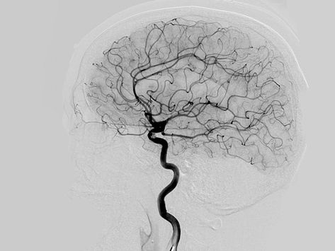 Cerebral angiography is a test to find blockages in the blood vessels of your head and neck. Learn about the procedure, risks, and more. Neuroscience Art, Neurology Art, Brain Drawing, Med School Motivation, Brain Art, Medicine Student, Neurology, Radiology, Anatomy Art