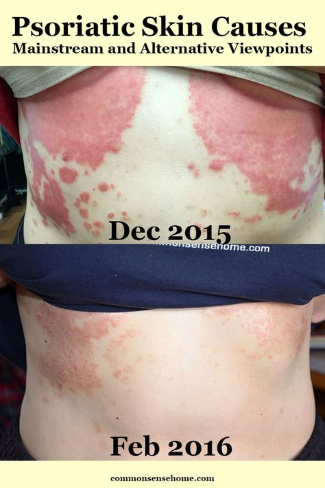 Psoriatic Skin Diet, Psoriatic Skin Remedies, Psoriatic Skin, Skin Diet, Health Nut, Skin Remedies, Medical, Diet, Lifestyle