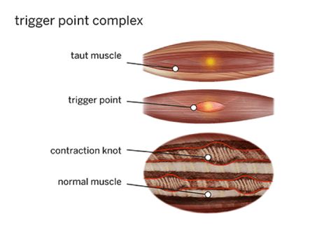 Hurts So Good: What is Self Myofascial Release Myofascial Release Massage, What Is Fascia, Fascia Blasting, Neuromuscular Junction, Hurts So Good, Referred Pain, Ligaments And Tendons, Trigger Point, Foam Rolling