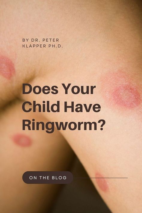 Ring Worm Remedies, Ring Worm, Skin Fungus, Natural Remedies For Migraines, Gymnastics Gym, Blood Sugar Diet, Dry Skin Remedies, Natural Sleep Remedies, Natural Cold Remedies