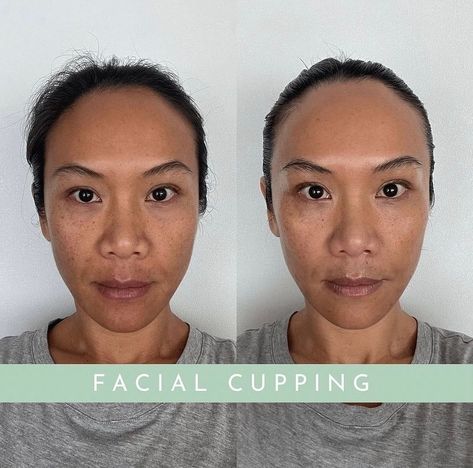 Facial Cupping Before & After Thank you to this lovely customer who shared her positive experience with facial cupping! Despite not having many wrinkles, she noticed her fine lines under her eyes have vanished, and her crow’s feet are much less visible when she laughs. Her complexion has also improved beautifully. She feels “more energized and radiant,” and her cheeks look and feel “fuller and more youthful.” For me, this is a massive win. Has anyone else started noticing results? #thefa... Face Cupping Before And After, Facial Cupping Before And After, Facial Cupping, Her Eyes, Facial Oil, Wrinkles, Facial, Beauty