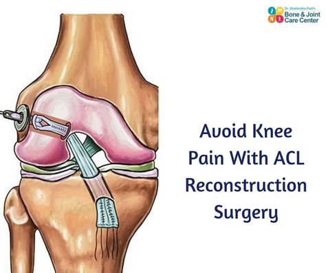 Acl Reconstruction Surgery, Inner Knee Pain, Acl Surgery, How To Strengthen Knees, Acl Tear, Neck Exercises, Knee Exercises, Reconstructive Surgery, Knee Replacement