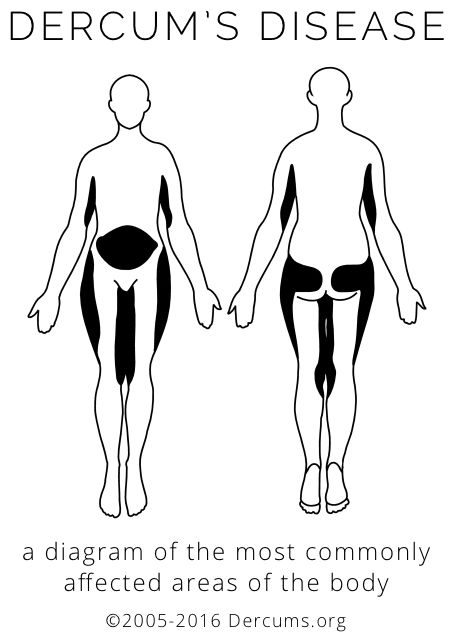 Dercums Disease, Neck Headache, Rare Disorders, Disease Symptoms, Genetic Disorders, Ehlers Danlos Syndrome, Adipose Tissue, Rare Disease, Thyroid Health