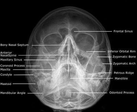 Radiographic Anatomy  of Facial Bones     Postero-Anterior Caldwell View       Occipito Mental (OM) (Waters) View       Postero-Anterior 30... Radiology Schools, Anatomy Head, Medical Radiography, Maxillary Sinus, Radiologic Technology, Radiology Student, Radiology Imaging, Facial Bones, Radiology Technologist