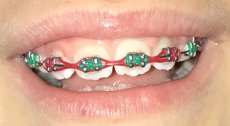 Christmas Braces Christmas Braces Colors, Christmas Braces, White Braces, Red Braces, Green Braces, Adult Braces, Cute Braces Colors, Orthodontic Appliances, Getting Braces