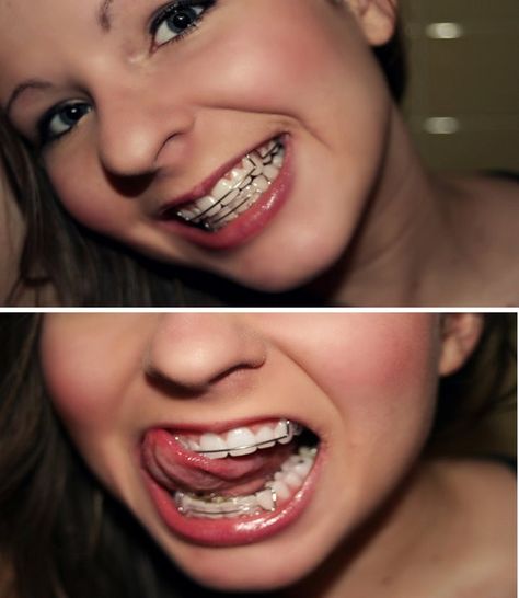 Girl wearing retainers. #braces #braceface #girlswithbraces #retainers Hawley Retainer, Braces Retainer, Retainer Teeth, Cute Braces Colors, Braces Girls, Cute Braces, Brace Face, Keto Diets