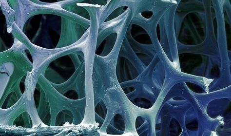 French scientists have created an injectable foam that helps repair and regenerate bone. It is made from calcium phosphate cements, a material commonly used as a bone substitute.The CPCs are macroporous, meaning their pores allow for the flow of nutrients. Though they'll still have to run more tests, the scientists hopes their product can eventually help fight bone disease, particularly osteoporosis. Around 54 million Americans have osteoporosis and low bone mass. Microscope Art, Inside Human Body, Bone Tissue, Bird Bones, Scanning Electron Microscope, Scanning Electron Micrograph, Microscopic Photography, Microscopic Images, Bone Diseases