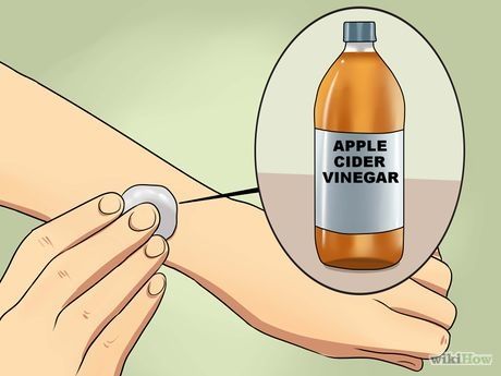 Plantar Wart Removal, Planters Wart, Facial Mole, Moles On Face, Warts On Face, Home Remedies For Warts, Remove Skin Tags Naturally, Warts Remedy, Antifungal Cream