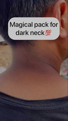 Remove Neck Darkness, Dark Neck, Remove Dark Spots, Glow Up?, Tanning, Dark Spots, Home Remedies, Skin Care Tips, Beauty Hacks